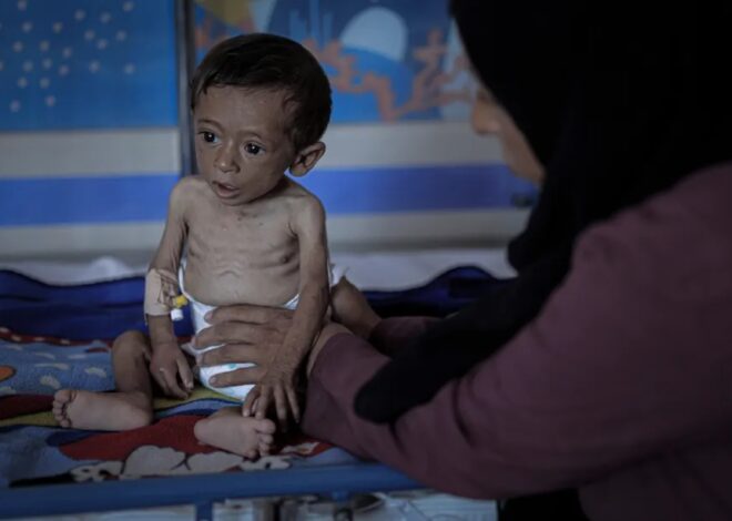 Why children are starving so much faster than adults in Gaza