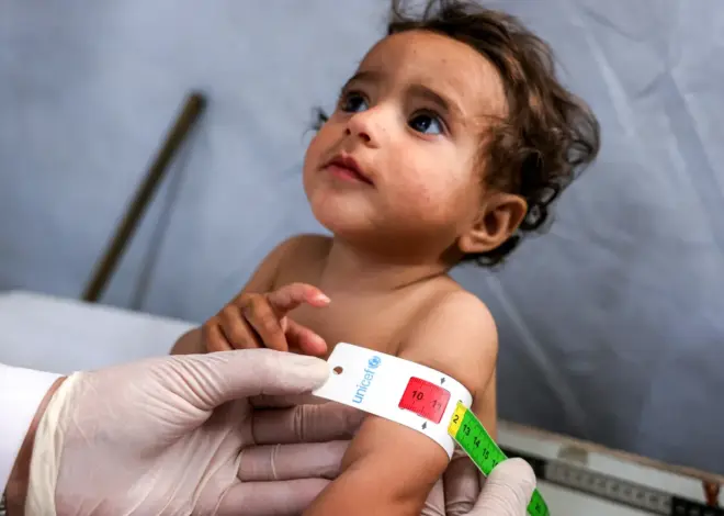 Rising maternal malnutrition in Gaza drives up newborn mortality