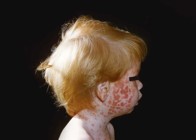 How RFK Jr.’s Vaccine Agenda Risks a Return of Childhood Plagues — ProPublica