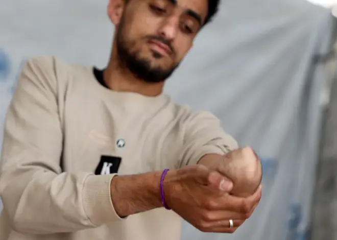 ‘I lost my life’: Gaza amputees fight for mobility amid shortages