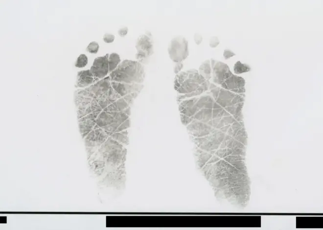 What I Learned About Vitamin K Deficiency From Babies’ Autopsy Reports — ProPublica